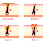 ニキビをキレイにつぶせるグッズ【ツメでつぶすより断然痕が残りにくい】
